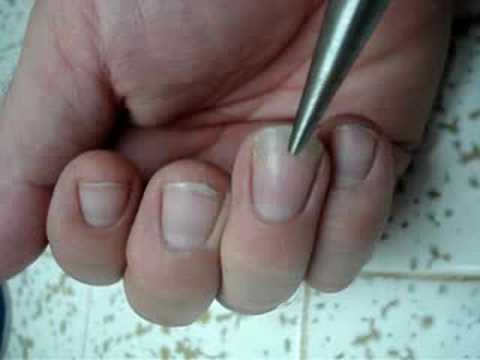 Smashed Fingernail update - grew back fine! Smashed Fingernail update - grew back fine! 0:11. Here's a short video of the finger that I had smashed. Smashed Fingernail update - grew back fine! Smashed Fingernail update - grew back fine! 0:11. Here's a short video of the finger that I had smashed.