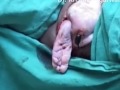 Assisted Breech Delivery