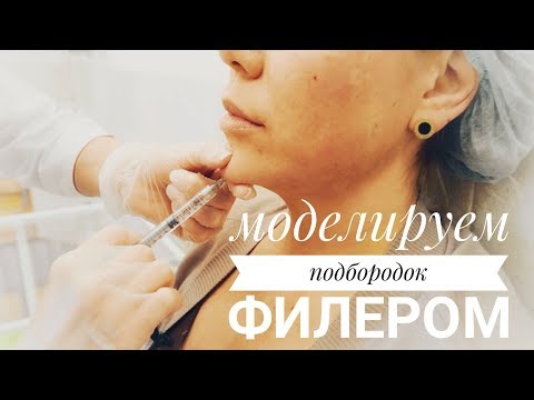 Моделируем подбородок филером и выполняем инъекции ботокс в лоб и междбровье. Оксана #2 Моделируем подбородок филером и выполняем инъекции ботокс в лоб и междбровье. Оксана #2