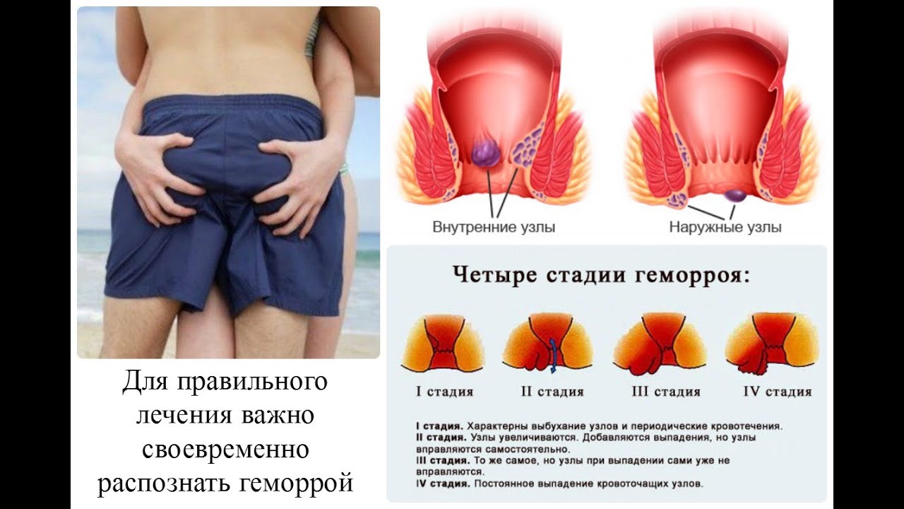 Как жить без геморроя? И как с ним бороться? - YouTube