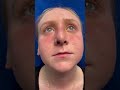Post op Septorhinoplasty Sinus Surgery Tonsillectomy 1 week ago and very happy with result