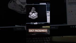 Cect Face & Neck On United Imaging 528