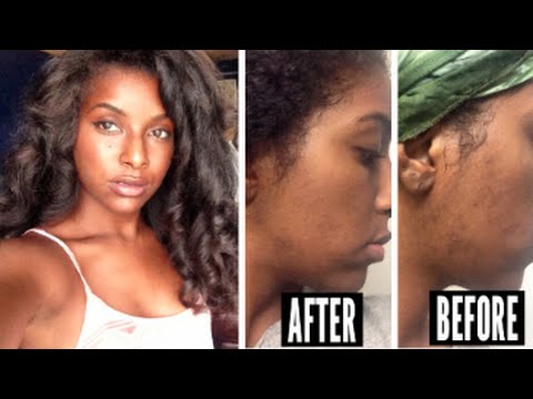 Acne Scars: Updated Skin Care Routine - Clarisonic, Cetaphil, Alpha H