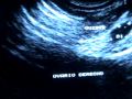 Vaginal Sonogram