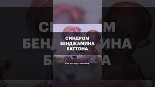 Болезнь, При Которой С Детства Стареешь