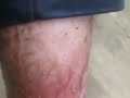 image Kaki Buruk Di Penuhi Ulat