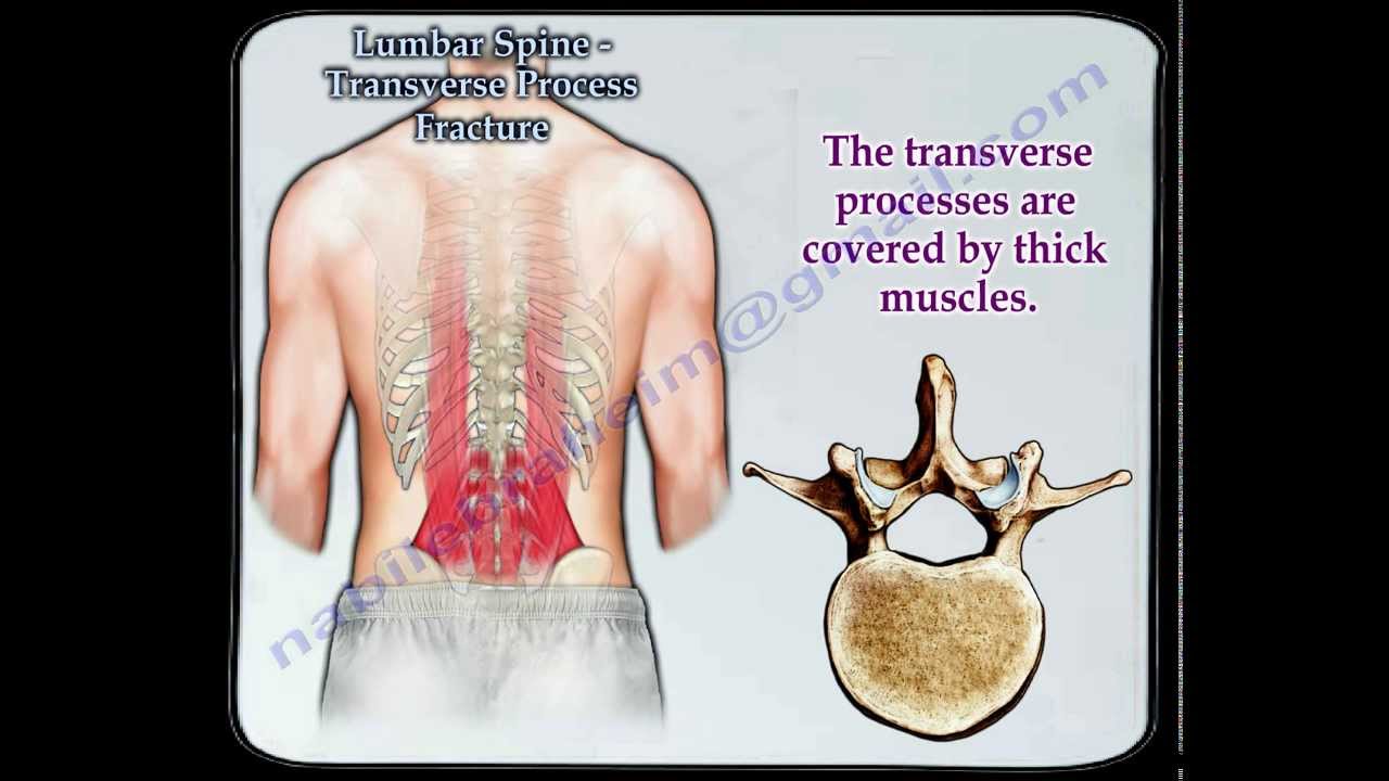 Lumbar Spine Transverse Process Fracture - Everything You Need To Know