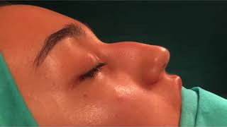 Celebrity Nosejob By Dr. Tas