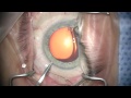phacotrabectome in narrow angle, low pressure glaucoma and floppy iris #2