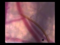 Mosquito finds blood vessel