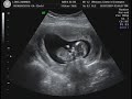 12 weeks 1 day Ultrasound