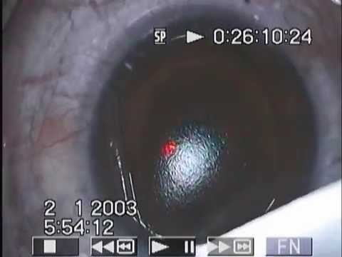 Eye Surgery Lasix Bangkok