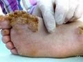 Extreme Warts | Embarrassing Bodies