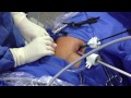 Single Incision Laparoscopic Appendectomy. (Dr. Mariano Palermo, Guillermo Duza).