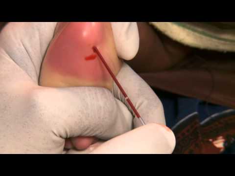Newborn Care Series: Taking a Heel Blood Sample