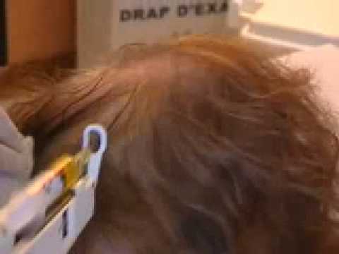 Le masque du pain noir pour les cheveux secs et fragiles