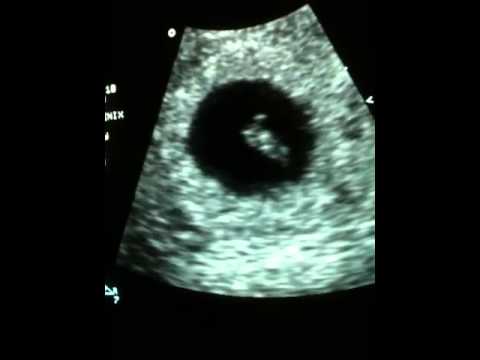 scan at 6 weeks 3 days