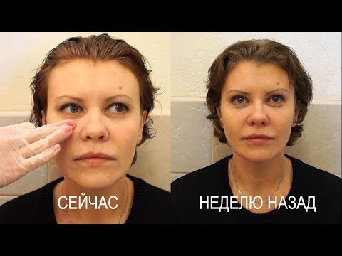 Оценка растворения филера гиалуронидазой и коррекция щечно-скуловой зоны. Светлана #2 Оценка растворения филера гиалуронидазой и коррекция щечно-скуловой зоны. Светлана #2