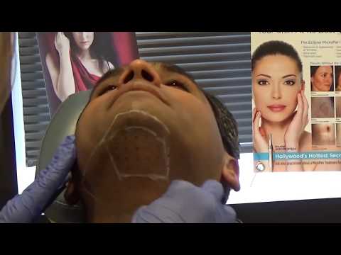 Kybella Denver