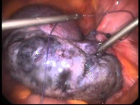 torsion adnexa ovarian cyst rt ms8