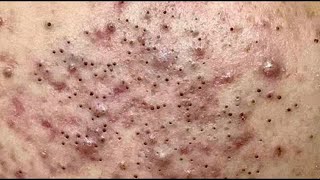 Hidden Blackhead Extraction - Acne Plample Popping