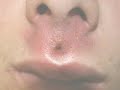 PERIANAL ABSCESS