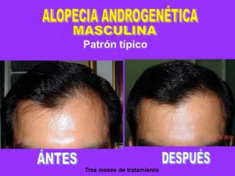 Las máscaras para los cabellos para la densidad y el crecimiento de los cabello las revocaciones