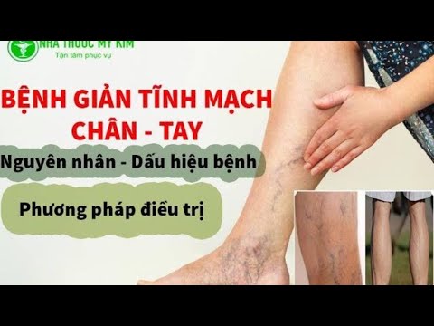 Bệnh suy giãn tĩnh mạch là gì ? Nguyên nhân Triệu chứng bệnh tĩnh mạch Nên và không nên ăn gì