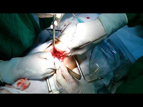 Lấy sỏi trong thận