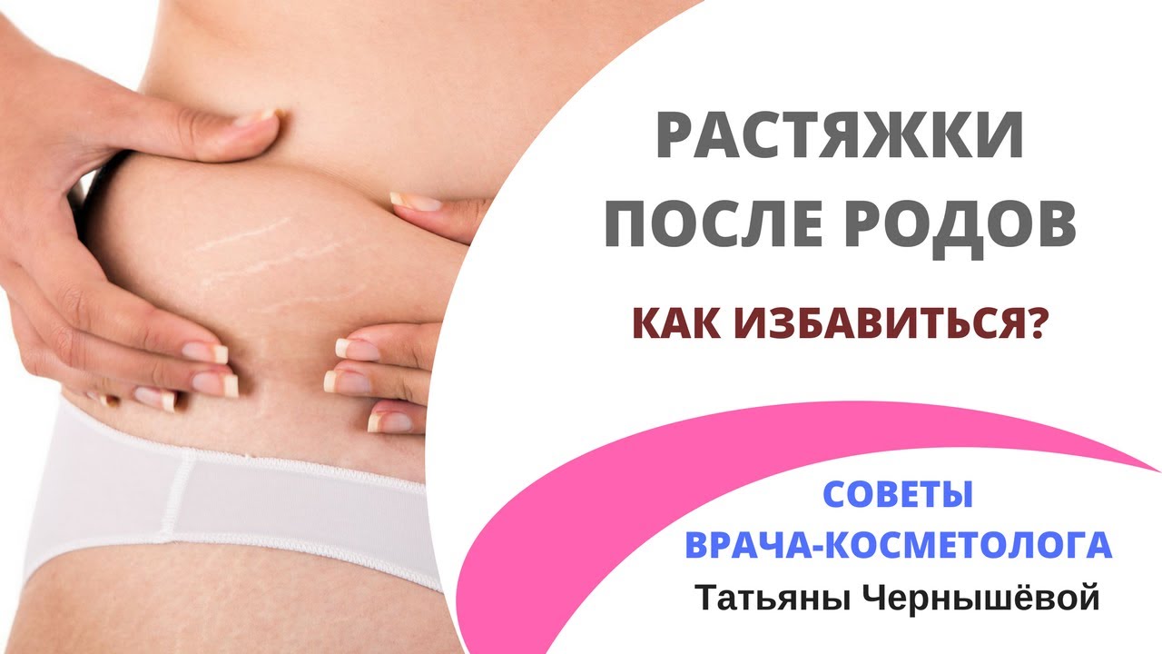 Избавится от растяжек в домашних условиях 78