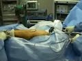 Arthroscopic Trochanteric Bursectomy and IT Band Release