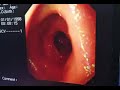 Demonstration of the third and fourth parts of the duodenum# using the upper digestive endoscopy#
