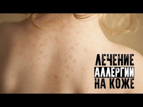 Лечение аллергии на коже Лечение аллергии на коже
