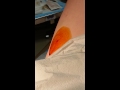 Cutting Open A Spider Bite images Cutting Open A Spider Bite