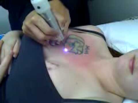 Co2 Tattoo Removal