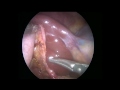 single incision laparoscopic cholecystectomy