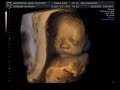 3D ultrasound  25 weeks, 4D view of baby