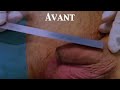 agrandissement penis