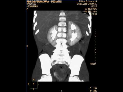 CT/TC Multislice horseshoe kidney - Rim em Ferradura - Reconstrução 3D e MIP