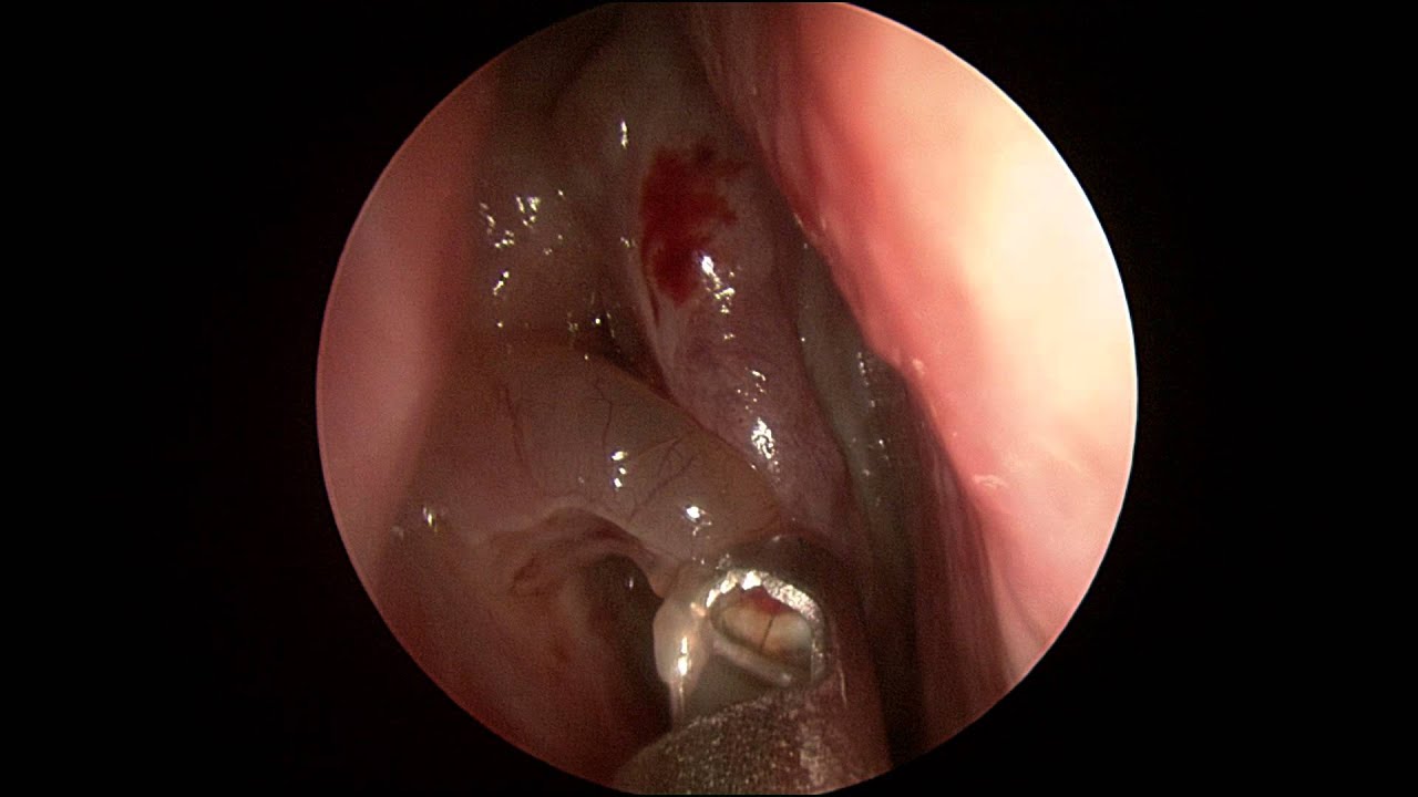 sinus issues with zoloft can nasal irrigation cause loss of odor