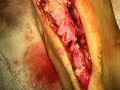 Ruptured Achilles Tendon Surgery