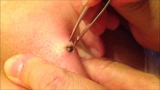 20 Year Old Blackhead Removed 20 Year Old Blackhead Removed