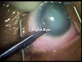 micro catheter