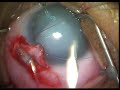 micro catheter