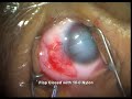 micro catheter