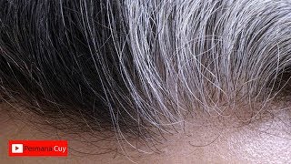 Hanya Dua Menit UBAN Di kepala Anda Akan Hilang, Begini Caranya
