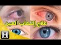 علاج إلتهاب العيون طبيعيا والتخلص من العمش وإحمرار العين في المنزل بأرخص وأسهل طريقة
