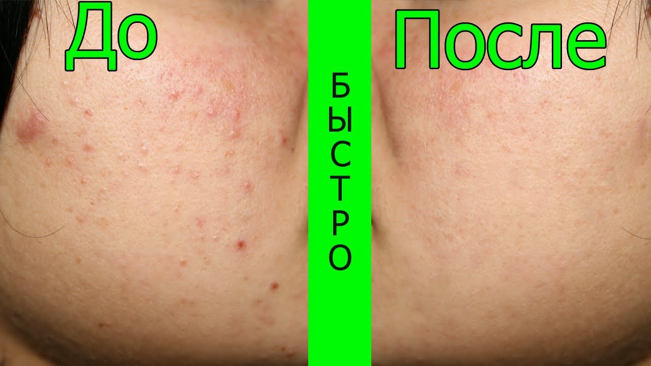 Избавляемся от прыщей на попе в домашних условиях Избавляемся от прыщей на попе в домашних условиях