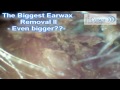 The Biggest Earwax removal II - Even bigger??? -A Maior cera de ouvido do mundo II Maior ainda???
