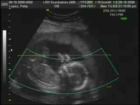 3d ultrasound 20 weeks boy. This is the second part of our baby oy Damian#39;s#39; 2d/4d narrated ultrasound at 18 weeks; courtesy of Dr. Lance Dursi from Los Gatos, CA.